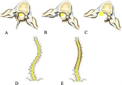 Case Report: Transvertebral transposition of the spinal cord for recovery after paraplegia during kyphoscoliosis surgery